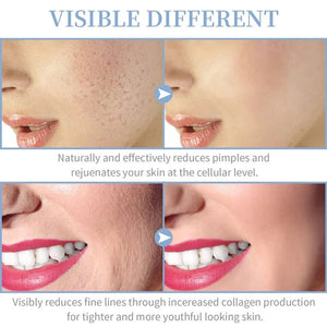Planet Gates High Frequency Skin Therapy Wand Machine Portable Handheld for Acne Massage Skin Rejuvenation Tightening Wrinkle Reducing Tool