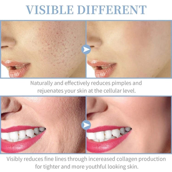 Planet Gates High Frequency Skin Therapy Wand Machine Portable Handheld for Acne Massage Skin Rejuvenation Tightening Wrinkle Reducing Tool