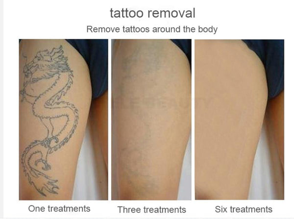 Planet Gates Picosecond laser tattoo removal machine Nd Yag laser 755nm 1064nm 532nm 1320nm beauty machine, skin whitening